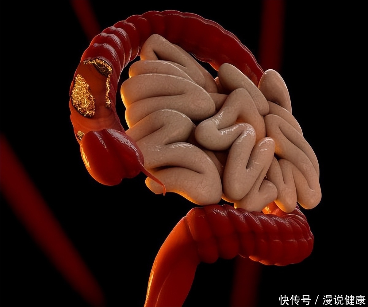 息肉是癌症的近亲到底要不要切除(被誉为癌症的“近亲”？若遇到这3种息肉，劝你最好及时切除！)