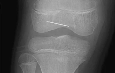  真相|有图有真相：那些年，孩子体内发现的硬币、钥匙、钉子、别针、电池……