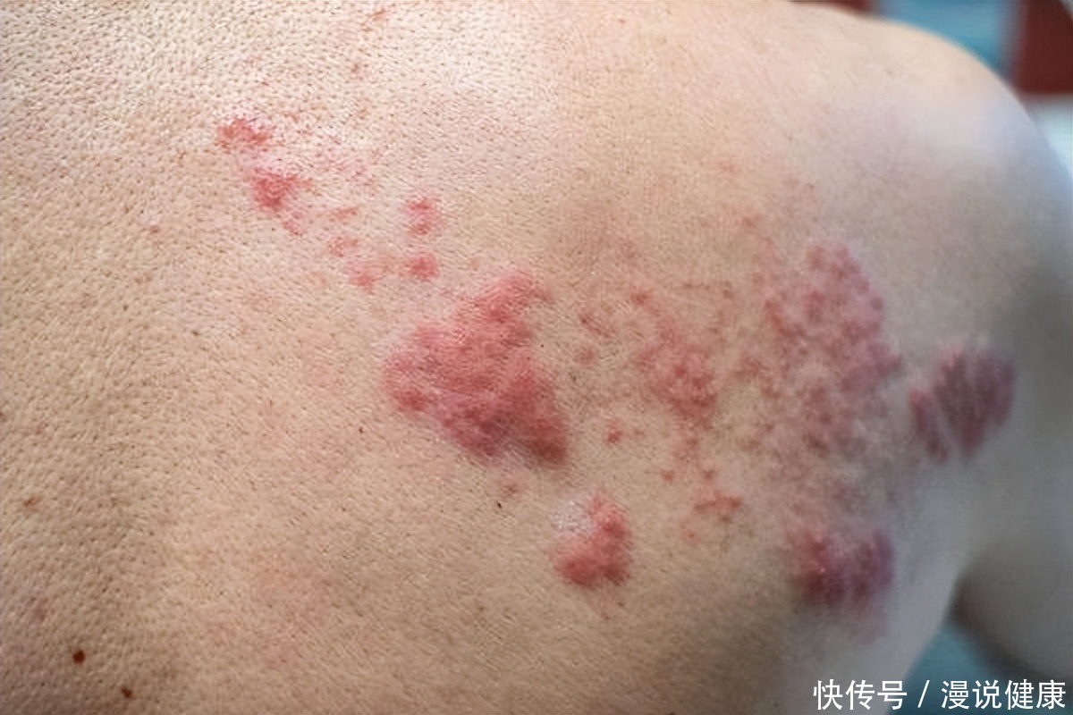 皮肤上长的湿疹是怎么引起的(皮肤长湿疹？身上的这4个迹象，警惕你小心患上这种“不死之癌”)