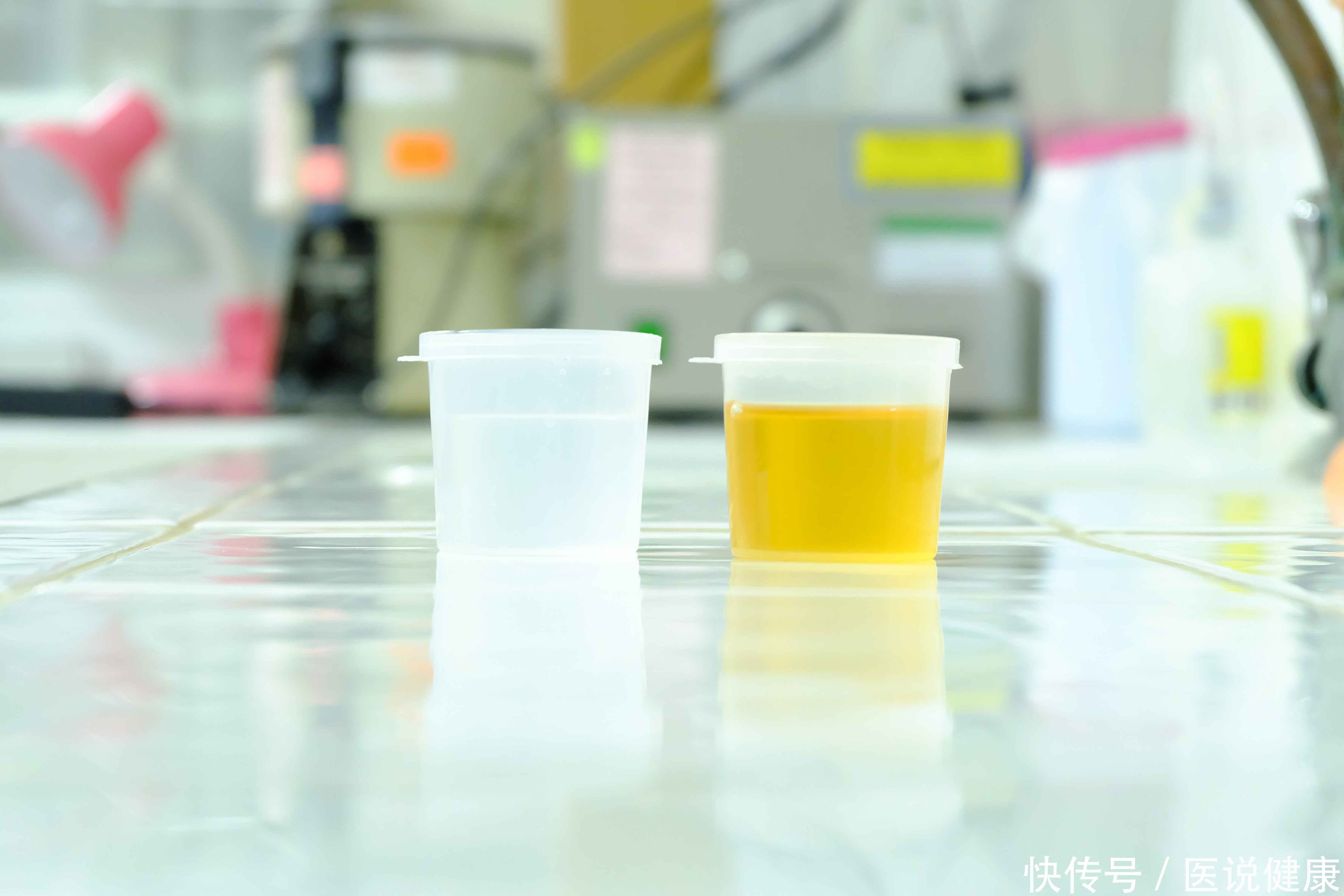 尿泡沫是尿毒症前兆吗(泡沫尿不一定是尿毒症，尿毒症早期的4个症状，需了解)