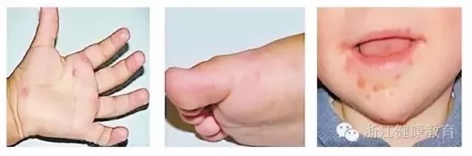 清洁|警惕!这个病的高发季到了!