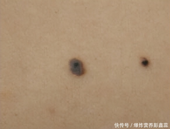 长在这几个地方的黑色痣，或是身体异常的表现，不能再忽视了2023