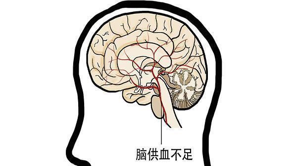  脑梗|脑梗发作跟什么有关？发作症状是什么？