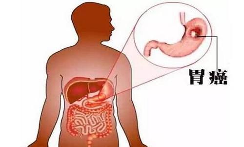  细胞|胃癌增强体质，避免转移，可以吃5种食物，很简单