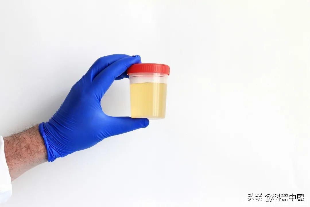 8种尿液颜色预示得了这些病(尿液变色是疾病前兆？关于尿液的 8 种颜色，一文说清！)