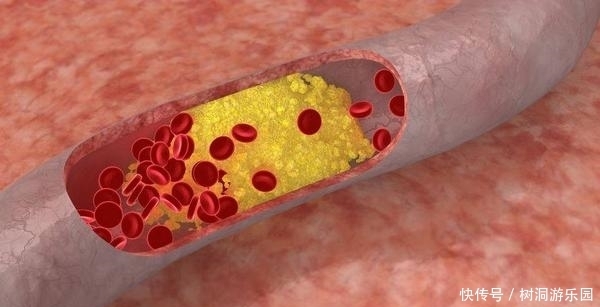  称为|这种蔬菜被称为“血栓斑块清道夫”，想血管畅通，日常不妨多吃点