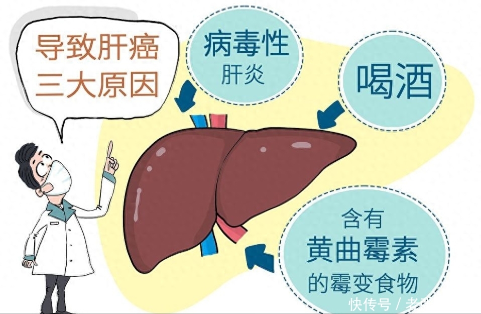 5种食物容易诱发肝癌(5种食物，或成为中国人患上肝癌的常见祸根，劝你尽量少摆上餐桌)