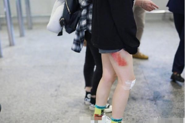 助理|黄龄摔下舞台后首现身,腿部一大片擦伤令人心疼,走路需助理搀扶