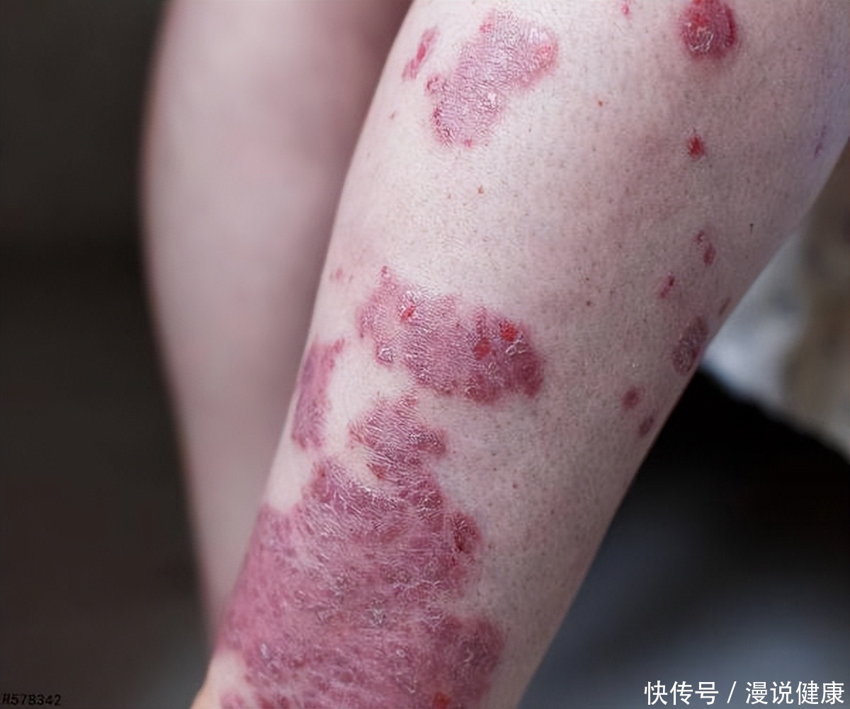 口腔感染hpv病毒的症状是什么样子(日常出现哪些症状，说明可能已感染HPV病毒呢？出现这些要留心)