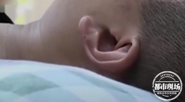  医生|“特别惊人！”男子觉得耳朵痒，检查才发现里面有虫