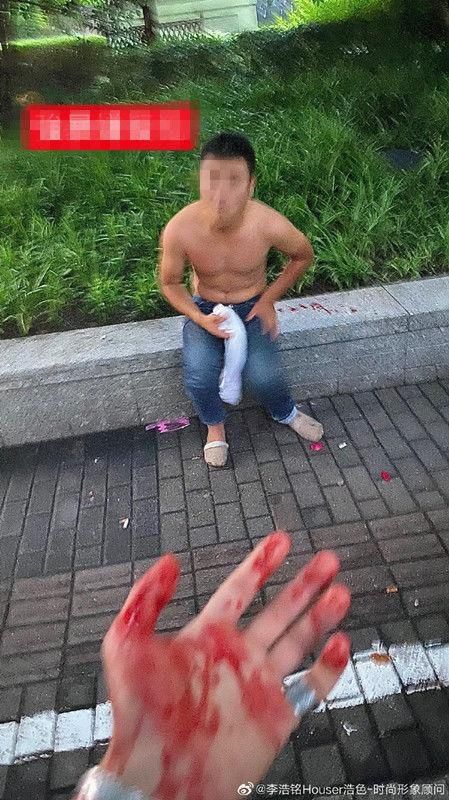  耳朵|＂大V＂见义勇为阻止性侵案被咬掉耳朵 嫌疑人仍在逃