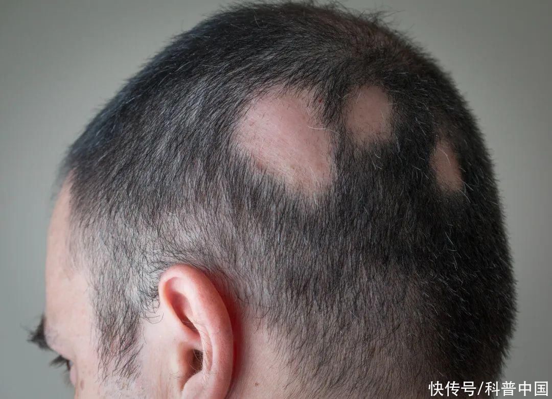 头上突然秃了好几块是鬼剃头吗(头上突然秃了好几块，是“鬼剃头”吗？)