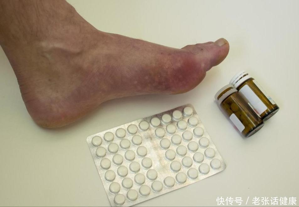 3种高嘌呤食物痛风患者要远离(提醒：这3种“高嘌呤”饮品，有痛风的人尽量不要碰，早做了解)