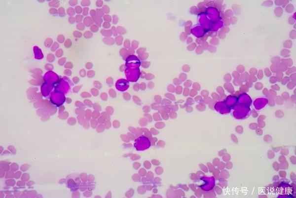 引起白血病的5个重要因素(为何白血病逐年高发？医生：多半与这6个致癌因素有关，需远离！)