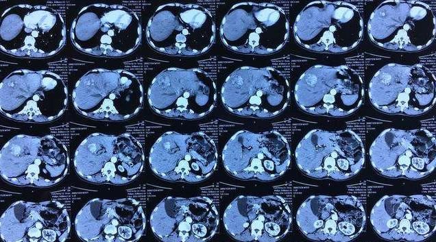  叹息|男子肝病晚期，痛哭流涕，叹息：面部早有迹象，只是被忽视了