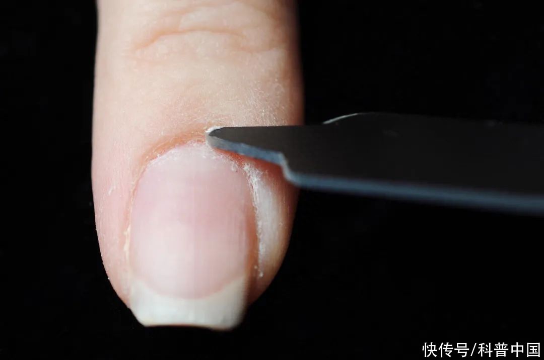 指甲长出黑线来千万别不当回事(指甲长出黑线来，千万别不当回事！)