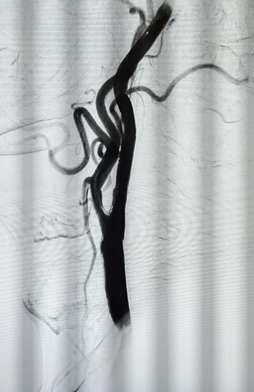  狭窄|七旬老人抽烟喝酒，潍坊市中医院东院区“保护伞”拦截血管中的“棉花”