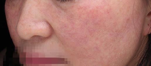  专家|脸越洗越敏感？毛孔越洗越大？皮肤专家说，那是因为你的脸洗多了