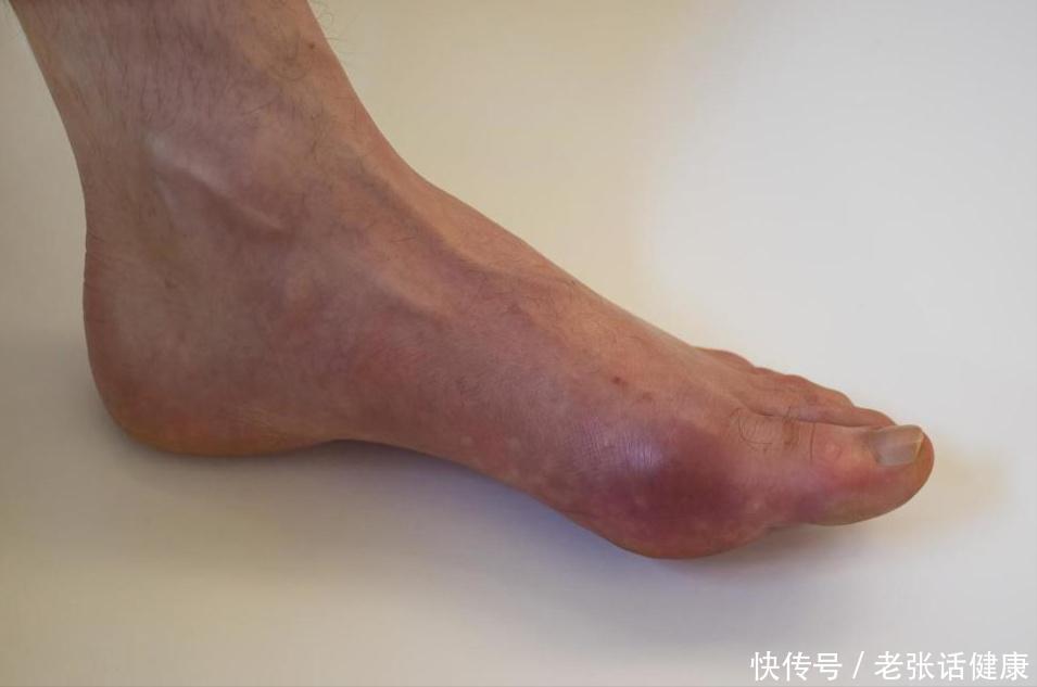 痛风到底可以吃豆制品吗(豆制品是痛风的“催化剂”？提醒：该少吃的是4种食物，早做了解)