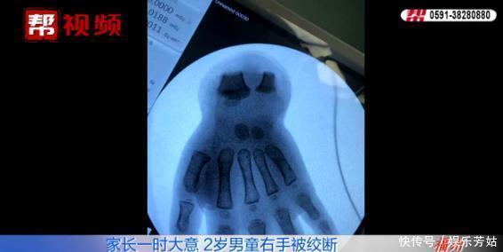  医生|家长来医院竟带着一只两岁男童的右手？在场所有人都惊呆了！