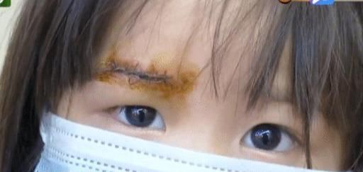  监护人|女儿在必胜客沙发摔下缝7针，母亲要求赔偿，必胜客该负责吗？