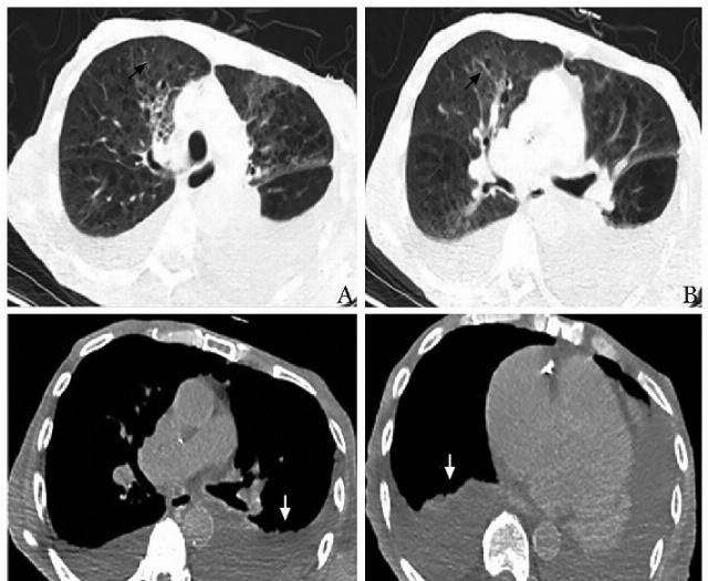  衰弱|皮疹，心力衰竭，肾功能不全，嗜酸性粒细胞增多：一例高龄衰弱老年患者