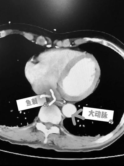  医院|吃鳊鱼不小心吞进一根骨头 徐女士连跑三家医院被送进手术室