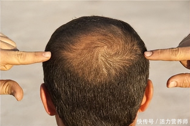 为什么脱发部位大多是前额和头顶(为什么中年脱发的人，总是先从头顶和前额开始？原因在这里)