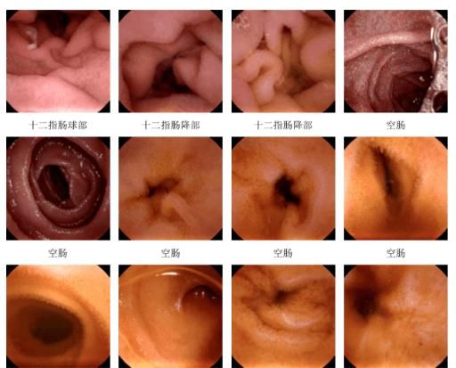 内镜|【广医时讯】胶囊内镜让患者不再“谈镜色变”