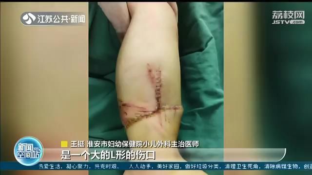  男童|好危险！两岁男童误启电动车 翻车缝了近60针