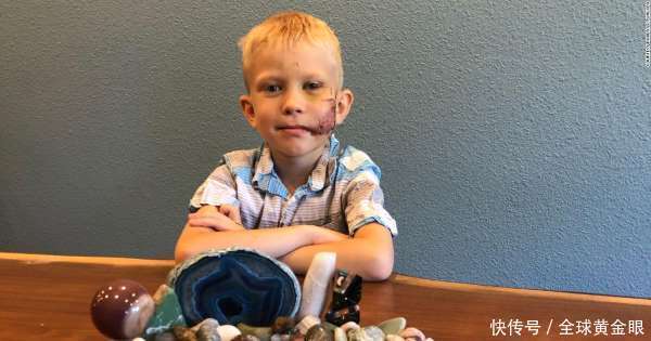  依旧|美6岁男孩为保护妹妹与恶狗搏斗，缝90针笑容依旧，获“绿巨人”盛赞