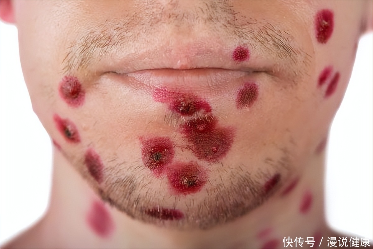 科普一下猴痘(猴痘只存在男男性行为？关于猴痘的这3点真相，最好事先有个清楚)