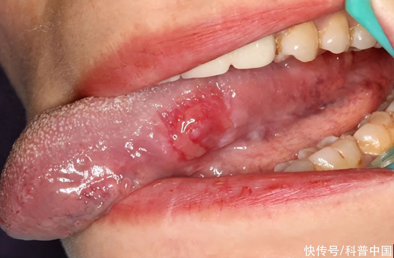 你以为是口腔溃疡，其实可能得了癌！赶紧张嘴看看2023