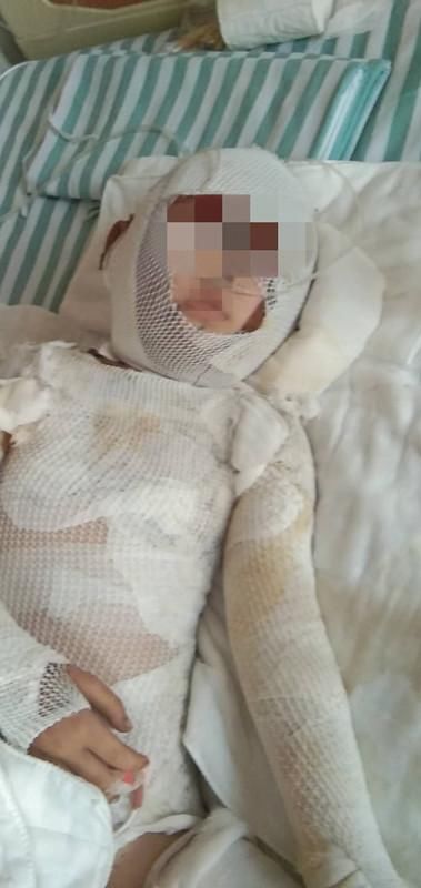  王迪|父子俩卖炸串收摊遇车祸 青县8岁男孩被热油烫伤