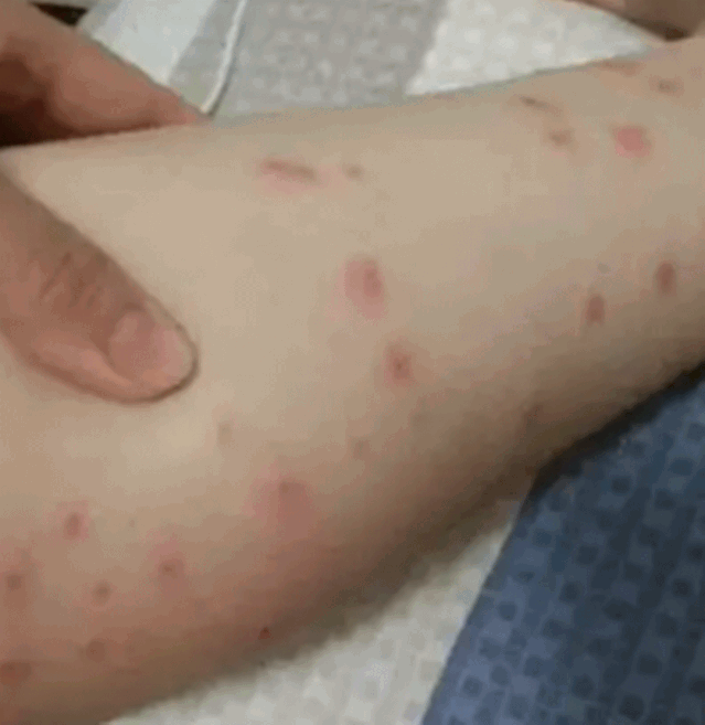  湘湖|杭州小伙去湘湖走了一圈，双腿被咬成这样！最近多人中招