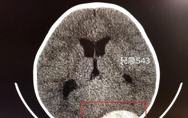  大脑|冲刺撞门倒头栽！1岁半娃凌晨诡异半瘫 医见大脑整块白惊呆