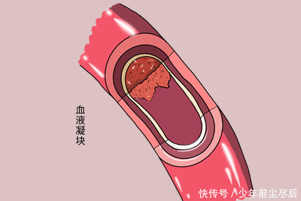 身上|血液变黏稠，疾病紧接着来，身上的3个信号，别再不当回事儿