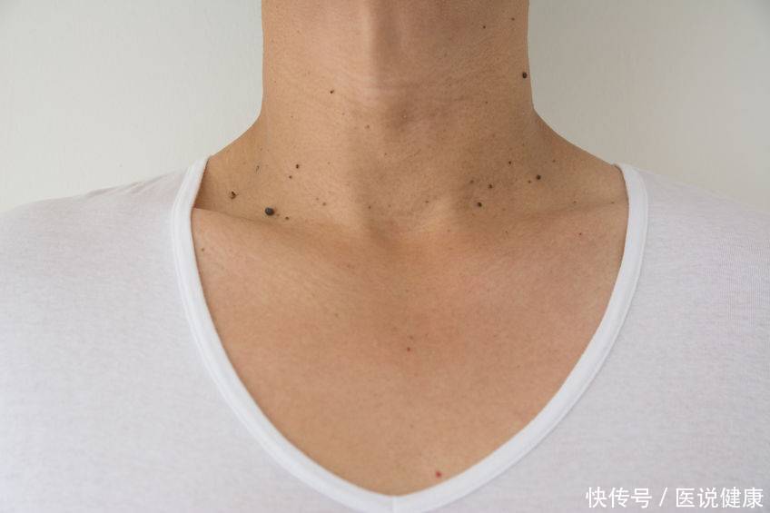 脖子上长小肉疙瘩什么原因引起的(脖子上长小肉疙瘩，别不当回事，这或是这些疾病的征兆！)