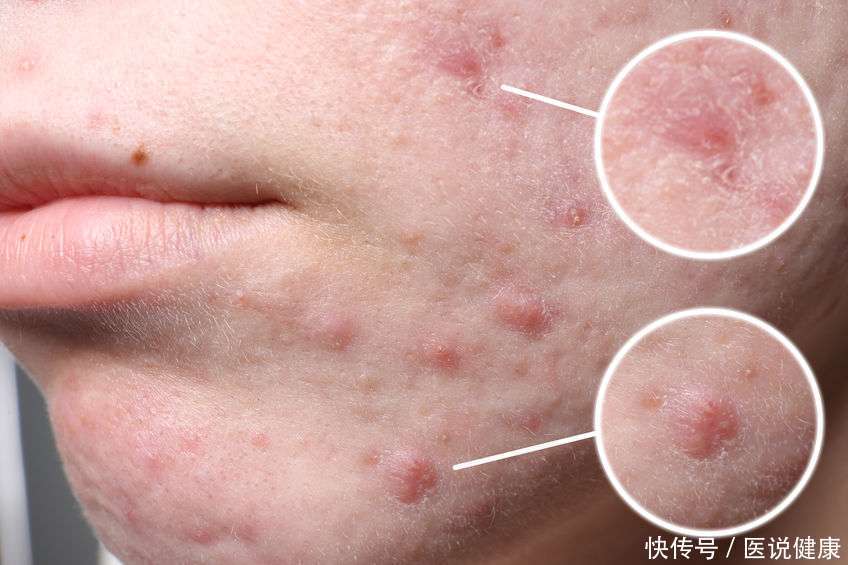 治疗毛囊炎的4种最佳方法(查出毛囊炎问题后，总结这4个治疗方法，或能有效缓解)