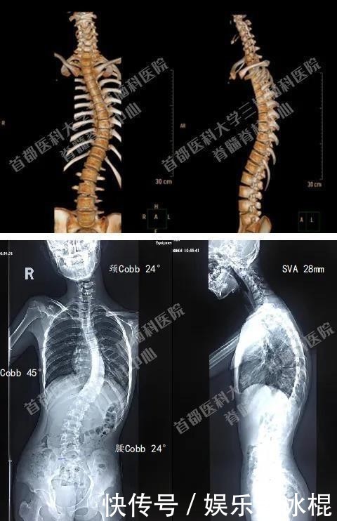 脊髓|非常罕见 15岁初中生莫名肢体无力 脊髓内竟然长满肿瘤