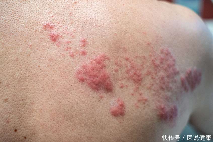 带状疱疹是不死的癌症吗(带状疱疹被称为“不死的癌症”，患者疼痛难忍，要引起重视)