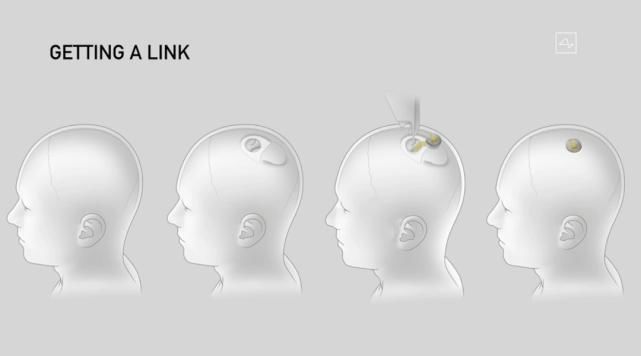  人脑|马斯克发布脑机接口：Neuralink无损植入猪脑，下一步植入人脑