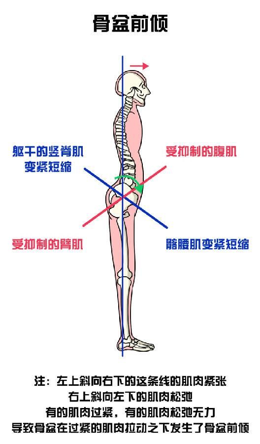  纠正|骨盆前倾危害大，如何自我测试和纠正？看这一篇就够了，男女通用