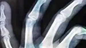  男子|男子碰瓷力求逼真，不惜施展苦肉计，自断手指