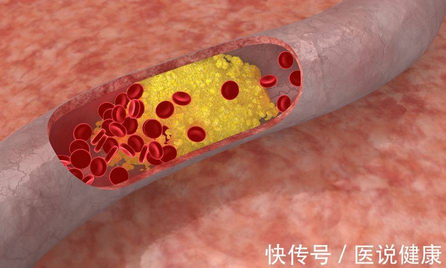 怎样缓解脑动脉硬化和预防(患有动脉硬化，建议做好3件事，或能有效缓解，降低脑血管风险)
