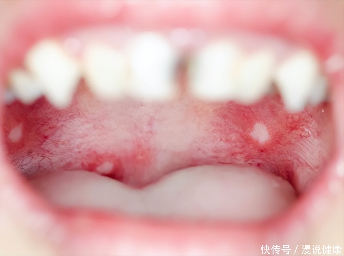 口腔溃疡与口腔癌如何区别(口腔溃疡还是口腔癌？要想辨别这两者，建议从这6个部位入手)