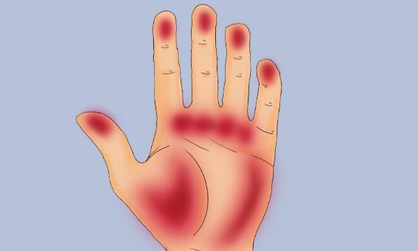  得了肝病|为什么肝病会引起皮肤瘙痒？肝病患者想要缓解瘙痒，需做什么？