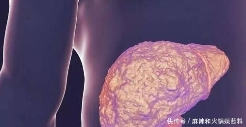 睡觉时|肝癌多是“拖”出来的,睡觉时有3种表现,可能肝病已经不轻了!