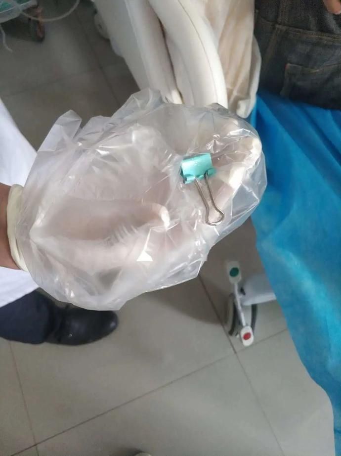  危险|危险！广南一人冲动吞下一枚燕尾夹