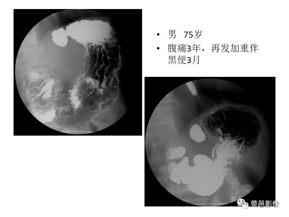 畸形|胃重复畸形CT诊断与鉴别诊断